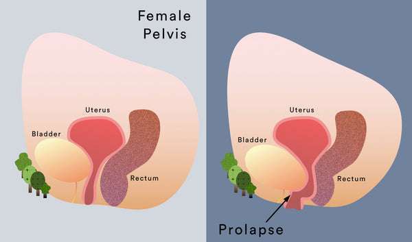 pelvic-organ-prolapse-how-to-stop-the-pop-the-iconic.jpeg